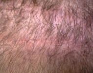 04Bob L. before scar revision