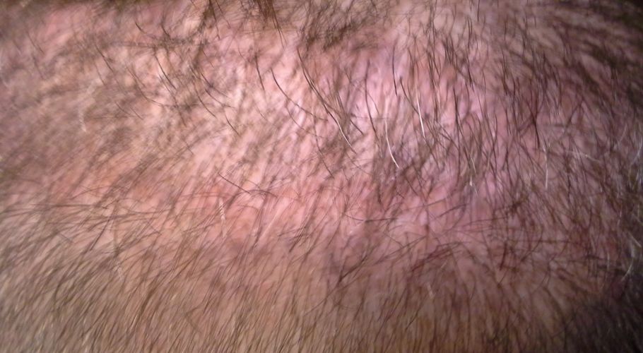 04Bob L. before scar revision