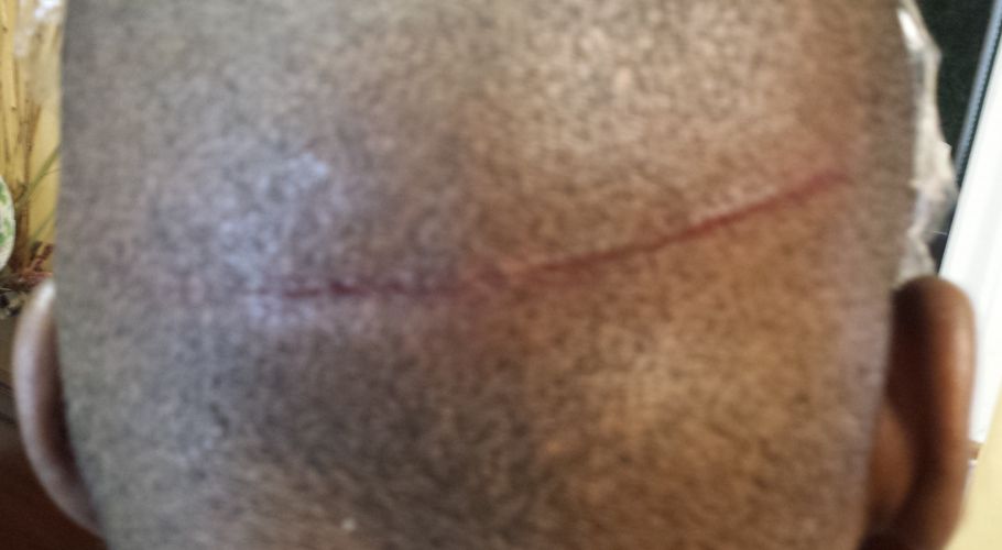 Ron after dry needling