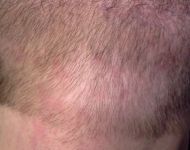 05Bob L after scar revision