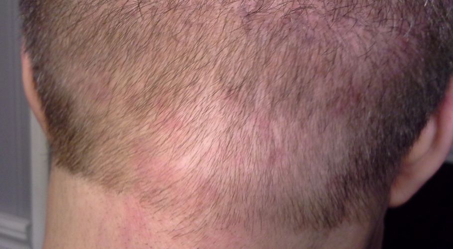 05Bob L after scar revision