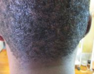 Ron after scar revision